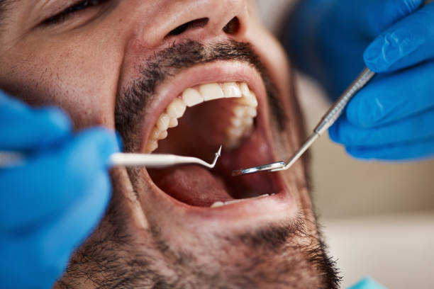 Best Emergency Tooth Extraction in Thornport, OH